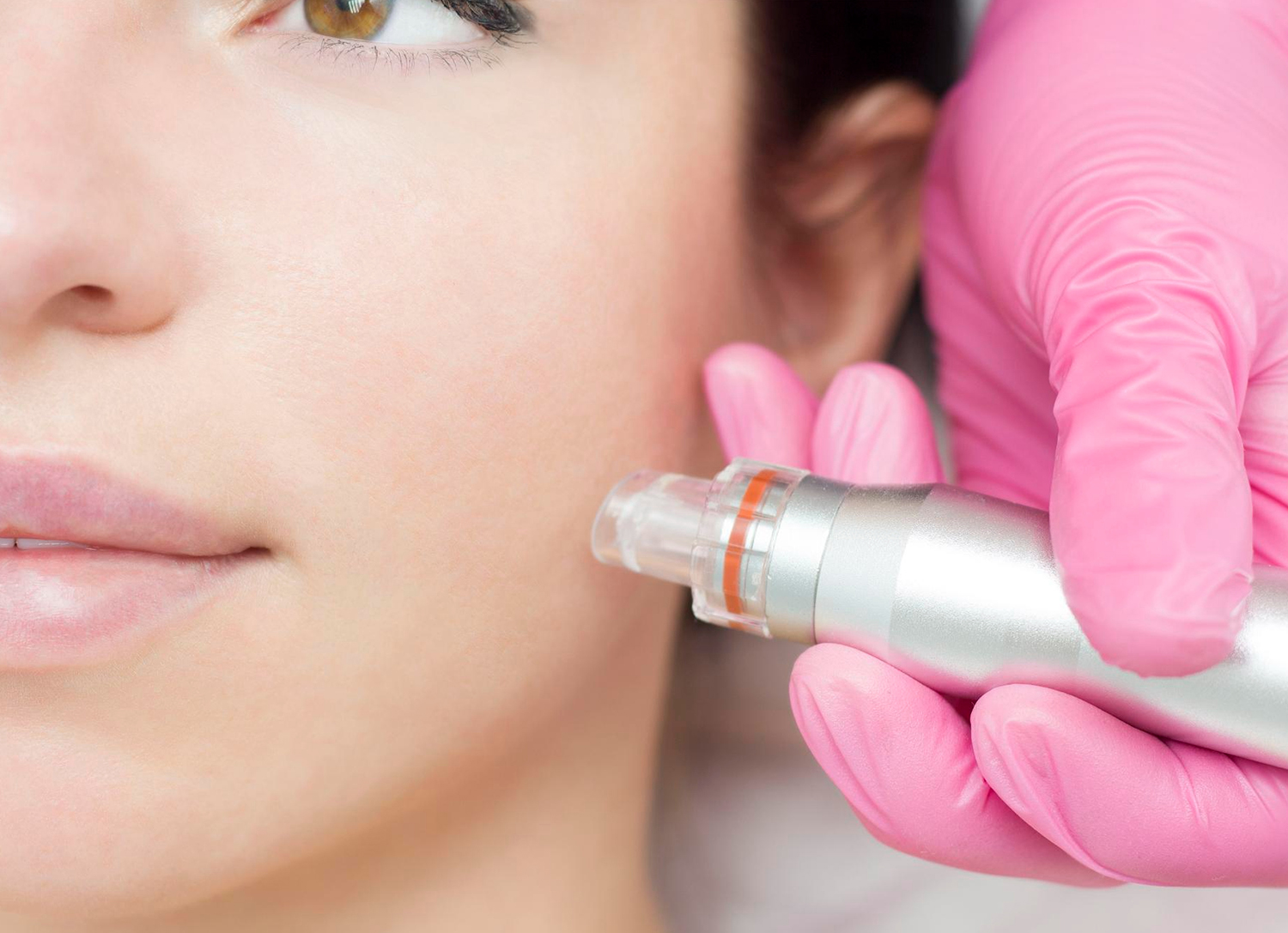 Microneedling RF Fractional